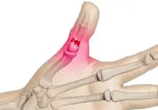 Thumb Fractures Images