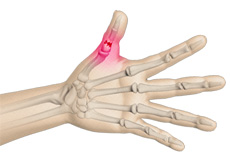 Thumb Fractures Images
