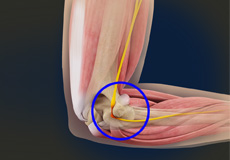 Ulnar Nerve Entrapment Images