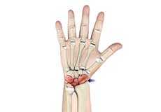 Arthritis of the Wrist Images