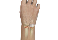 Wrist Fracture Images