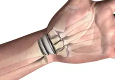 Wrist Joint Replacement Images