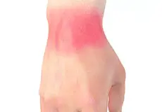 Wrist Sprains Images