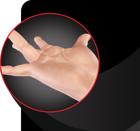 Dupuytren’s disease