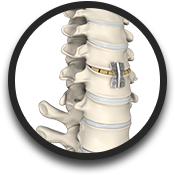 Anterior Cervical Discectomy & Fusion