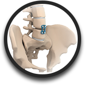 Anterior Lumbar Interbody Fusion
