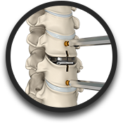 Cervical Disc Replacement