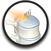 Laser Spine Surgery