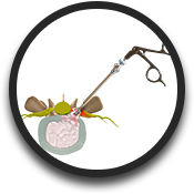 Lumbar Microdiscectomy