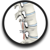 Posterior Lumbar Fusion