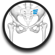 Sacroiliac (SI) Joint Fusion