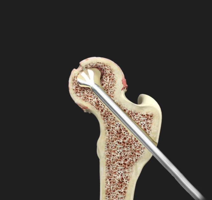 Core Decompression for Avascular Necrosis of the Hip