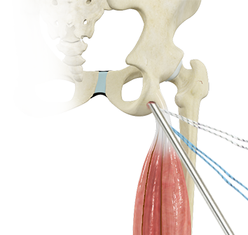 Endoscopic Proximal Hamstring Repair