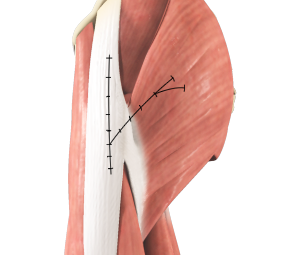 Gluteus Maximus Transfer