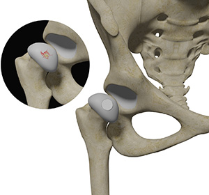 Hip Cartilage Restoration