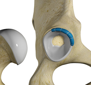 Hip Labral Reconstruction