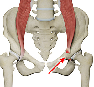 Iliopsoas Tendon Lengthening