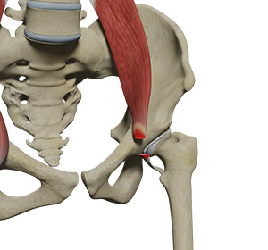 Surgical Release of Iliopsoas Tendon