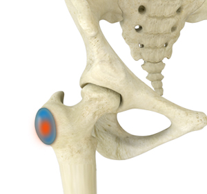 Trochanteric Bursitis