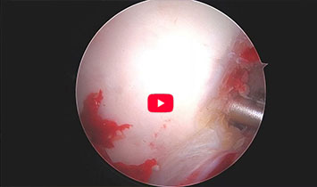 Arthroscopic Labral Reconstruction: Pull-Through Technique and Suction Seal Restoration
