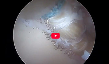 Capsule Scarring Reconstruction & Suction Seal Demonstration