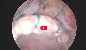 Demonstration of Labral Reconstruction Suction Seal Restore