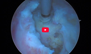 Endoscopic Proximal Hamstring Tendon Repair Overview