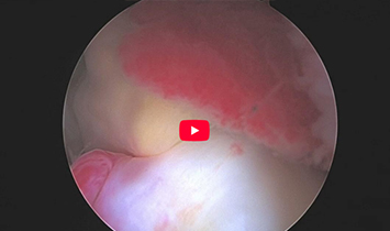 Excision of Synovial Nodule & Labral Repair Surgical Overview