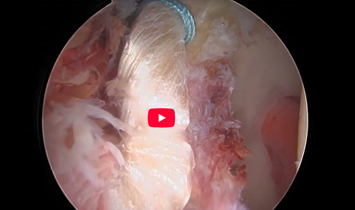 Fibertak Knot Cutter Surgical Technique: Pearl Labral Augmentation