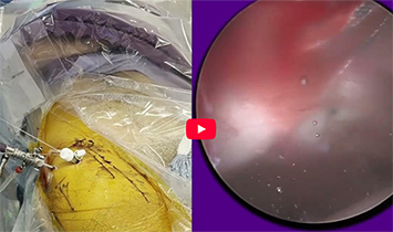 Hip Labral Repair 2010 and 2026