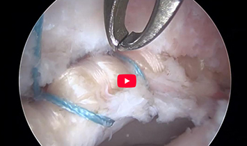 Labral Augment Pull-Through Procedure Guide