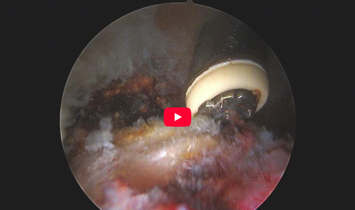 Labral Augmentation Surgical Technique Demonstration