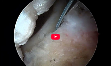 Labral Reconstruction in Ehlers-Danlos Syndrome (EDS): Addressing Failed Labral Repair