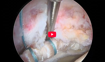 Revision Labral Reconstruction Surgical Procedure