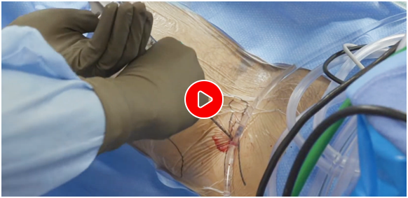 Patient Surgical Videos - Educational Picture