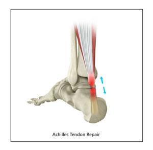 Achilles Tendon Repair pic