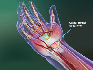 Carpal Tunnel Syndrome pic