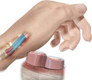 De Quervain’s Tenosynovitis pic