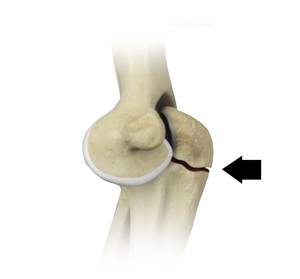 Olecranon (Elbow) Fractures pic
