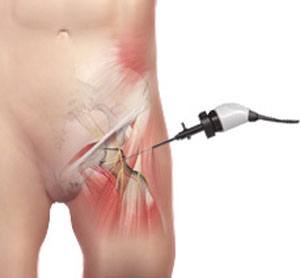 Hip Arthroscopy pic
