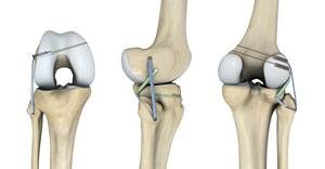 Ligament Preservation/Repair pic