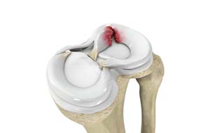 Meniscus Tear pic