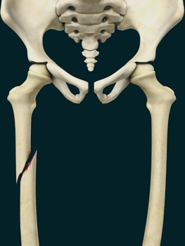 Pediatric Thighbone (Femur) Fracture pic