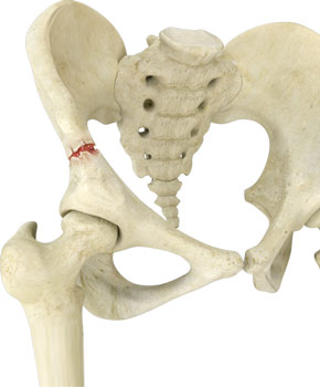 Pelvis Fractures pic