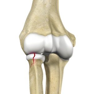 Radial Head Fractures pic