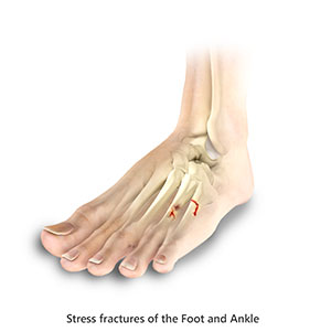 Toe and Forefoot Fractures pic