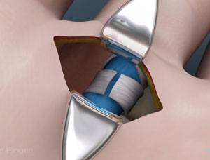 Trigger Finger Release pic