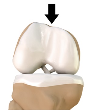 Trochlear Dysplasia and Trochleoplasty pic