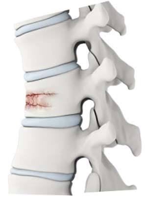 Vertebral Fractures pic