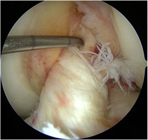 Primary Anterior Cruciate Ligament Repair Img1